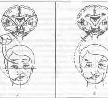 Ролята на лицевия нерв в проявите на болка на лицето