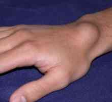 Сарком на меките тъкани в областта за ръката и китката: причини, лечение