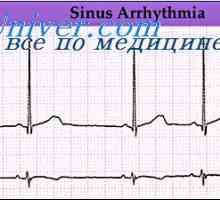 Сърдечни аритмии. Нарушаването на ритъма на синусовия възел