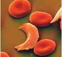 Сърповидно-клетъчна анемия: симптоми, причини, лечение, симптоми