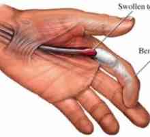 Trigger пръст: причини, лечение, симптоми, признаци, превенция