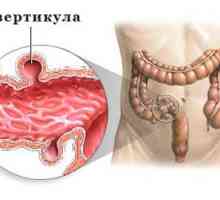 Симптоми и лечение на дивертикулоза сигмоидното дебело черво