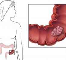 Симптомите на полипи в дебелото черво