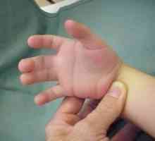 Синдактилия на пръстите на ръцете: причини, симптоми, лечение, симптоми