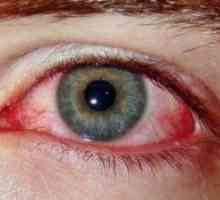 Синдром на червени очи: Лечение