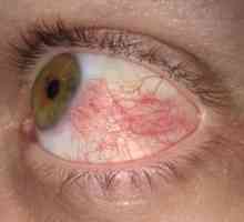 Склерити очите: лечение, симптоми, причини, симптоми