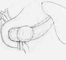Pseudopapillary-твърд тумор на панкреаса