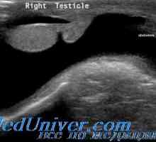 Spermatocele и хидроцеле при деца. тумори на тестисите