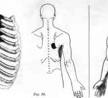 Болки в гърба, причинени от serratus предната мускула