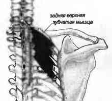 Болки в гърба, причинени от serratus
