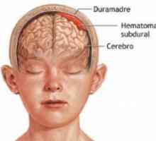 Субдурален хематом мозъка: последици за третиране