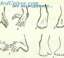 Тератология. Нарушенията на ръцете и краката на ембриона