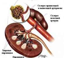 Краен стадий на бъбречно заболяване (хронична бъбречна недостатъчност), диабет