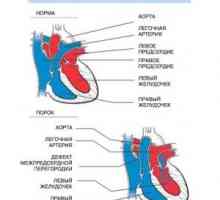 Транспониране от най-големите артерии: причинява, хирургия, лечение, симптоми, признаци