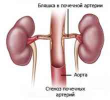 Тромбоза на бъбречните артерии