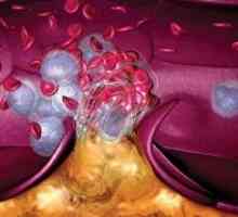 Тромбоза и белодробна емболия