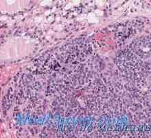 Туберкулоза на щитовидната морфология, патоанатомия