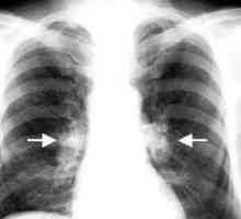 Туберкулоза на интраторакални лимфни възли: лечение, усложнения, причините, симптомите