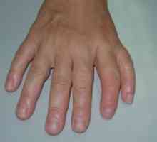 Удвояването на първия пръст (или лъч preaxial полидактилия)