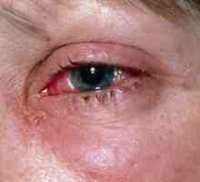 Синини и увреденото око: лечение, оказване на първа помощ, причини, симптоми, знаци