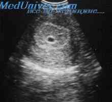 Ултразвук в първия триместър на бременността. Показания за трансвагинална ехография в първия…
