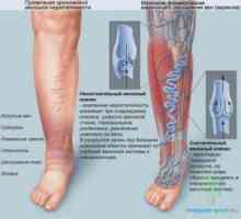 Разширените вени на краката, лечение, симптомите
