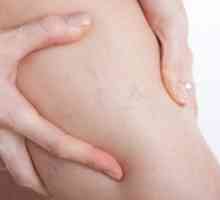 Разширените вени, разширени вени по време на бременност, причини, симптоми, лечение