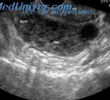 Видове извънматочна бременност. Локализация на извънматочна бременност