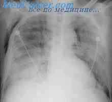 Ефект интраваскуларна въздух към белите дробове. Влияние повторна компресия на белите дробове