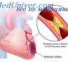 Вентрикуларна фибрилация след инфаркт на миокарда. вентрикуларна инфаркт на скъсване стена в зона