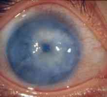 Средно глаукома око: лечение, причини, класификация, симптоми, признаци