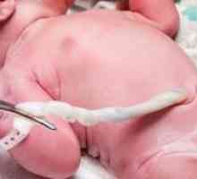 Пролапс на пъпната връв при раждането: ефектите, причините