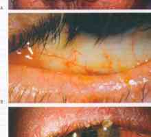 Заболявания на конюнктивата очна розацея