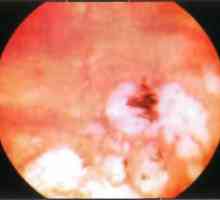 Заболявания на периферията на ретината: ретинална дегенерация на тип "паважа"