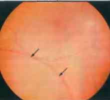 Заболявания на периферията на ретината: дегенеративни Ретиносхиза