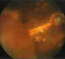 Заболявания на периферията на ретината, отлепване на ретината: ексудативна
