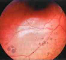 Заболявания на периферията на ретината: периферна групирани пигментация