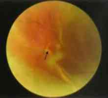 Заболявания на периферията на ретината: регматогенно отлепване на ретината. Епидемиология и…