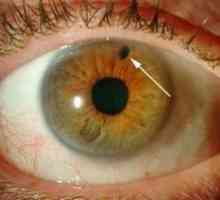 Глаукома със затворен ъгъл: лечение, симптоми, причини, симптоми