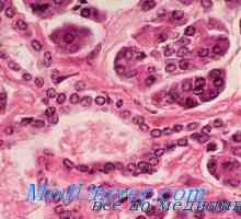 Злокачествен insuloma. Морфологията на тумори Лангерхансови островчета