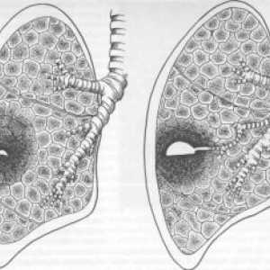 Lung абсцес: симптоми, лечение, диагностика, усложнения, причините, симптоми