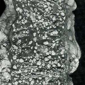 Аденоматозна (семейство) полипоза на дебелото черво