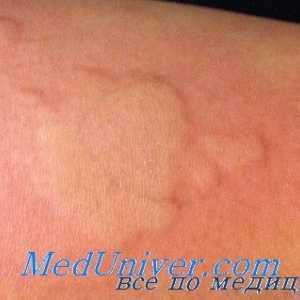 Adrenostimulyatorov алергии. Антихолинергични с алергични реакции