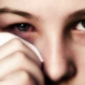 Алергичен конюнктивит: лечение, симптоми, причини, симптоми