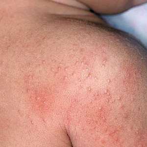Алергия дисбактериоза