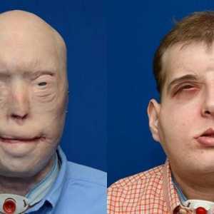 Американските лекари са трансплантирани лицето овъглена пожарникар