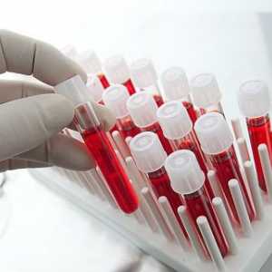 Кръвни тестове за opistorhoz (IFA, Biochemistry), антитела (ATM)