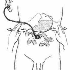 Supravaginal ампутация на маточното тяло