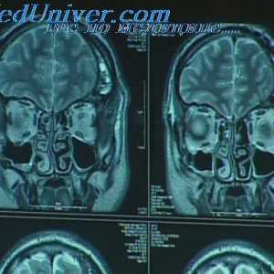Focal епилепсия. Оперативно лечение на епилепсия