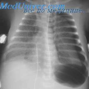 Баротравма белите дробове по време на декомпресия. Патогенезата на белодробна баротравма